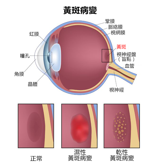 眼底黄斑病治疗最新方法揭秘