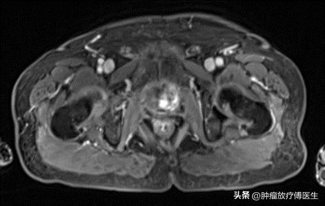 前列腺治疗最新进展，科技重塑健康，引领未来生活新希望