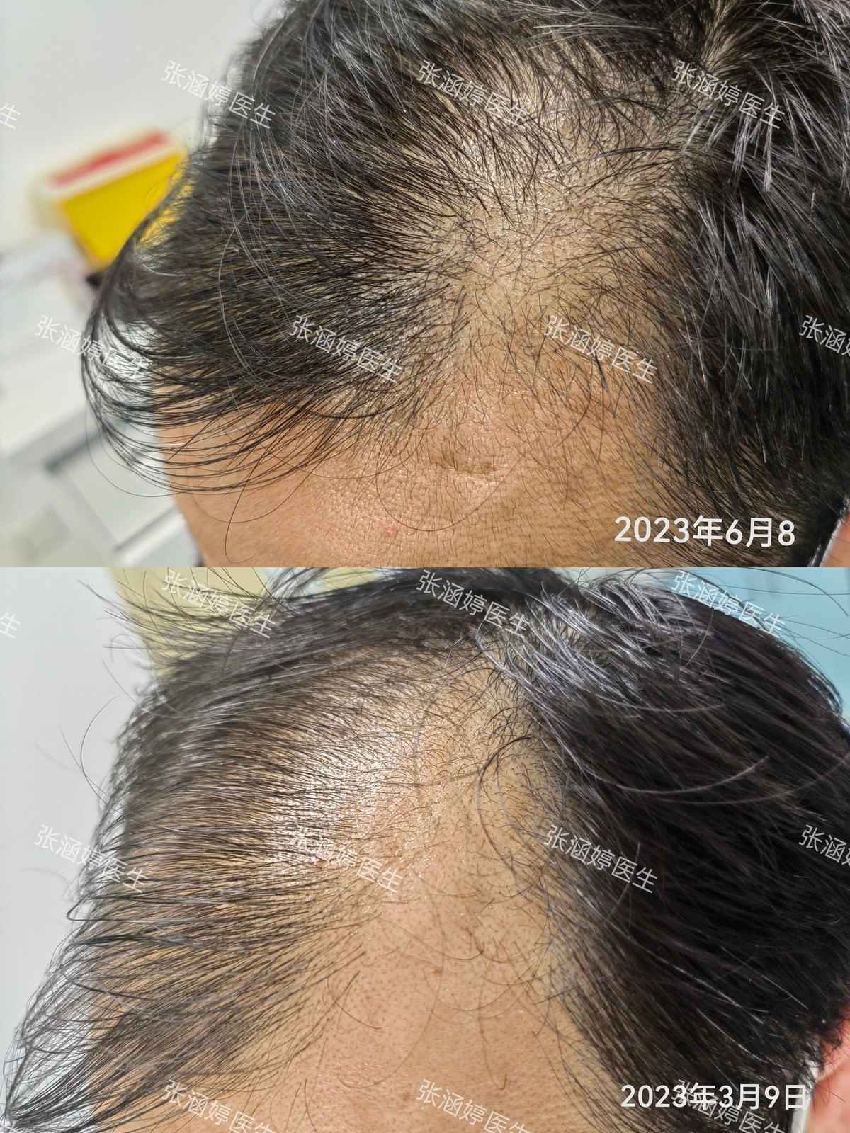 🌟最新脱发治疗方法，告别秃顶烦恼，重塑自信秀发💖