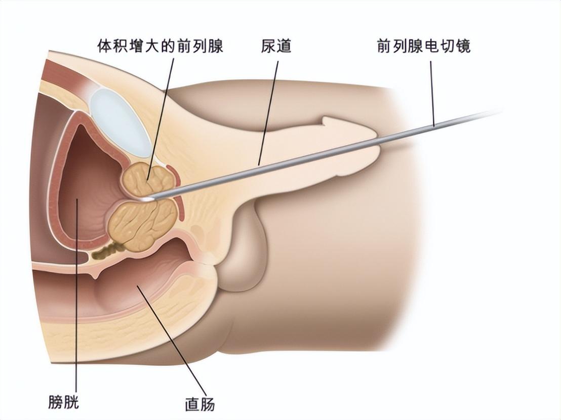 前列腺治疗最新进展,科技重塑健康,引领未来生活新希望