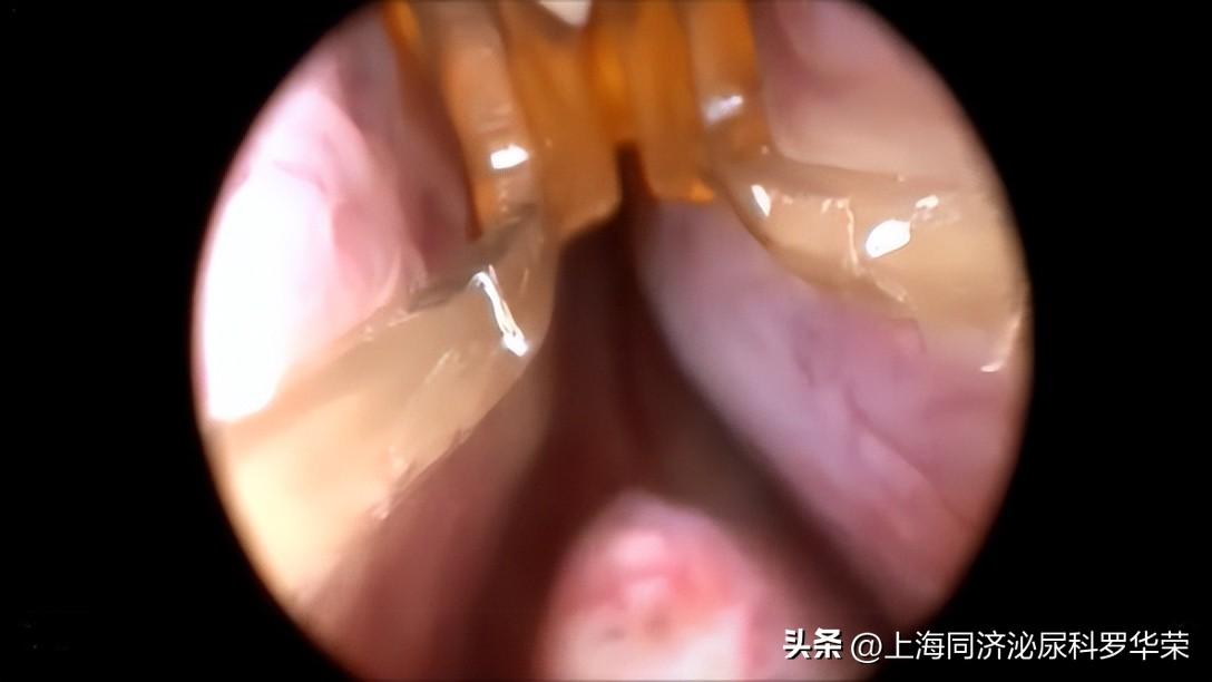 前列腺治疗最新进展,科技重塑健康,引领未来生活新希望