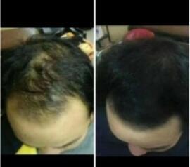 🌟最新脱发治疗方法,告别秃顶烦恼,重塑自信秀发💖